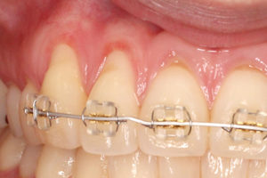 治療中の歯ぐきの退縮